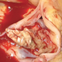 The role of nucleic acid amplification techniques (NAATs) in the diagnosis of infective endocarditis