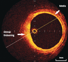 Figure 1. Optical coherence tomography (OCT) shows the three-layer appearance of normal vessel wall. The muscular media appears as a low signal layer between internal and external lamina (2 o’clock). Intimal thickening is seen at 6–9 o’clock