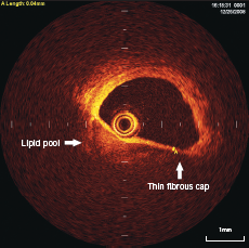 Figure 3. OCT appearance of lipid pool (3–9 o’clock position) with overlying thin (40 µm) fibrous cap. This is the typical appearance of thin cap fibro-atheroma (TCFA)