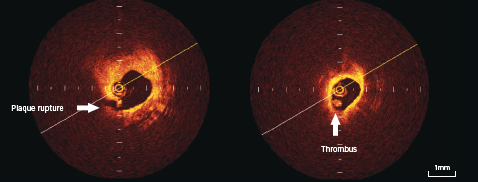 Figure 4. OCT appearance of plaque rupture (6 o’clock position) on left-sided panel, with intraluminal thrombus seen in right-sided panel