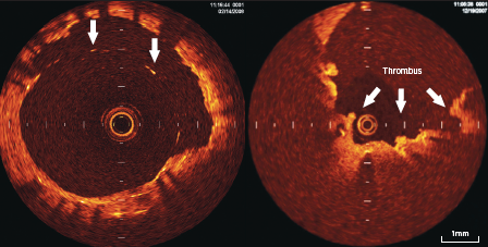 Figure 5. OCT appearance of stent struts inapposed to the vessel wall (arrows) seen from 10–3 o’clock position on left-sided panel, with overlying thrombus on some of the stent struts as seen on right-sided panel