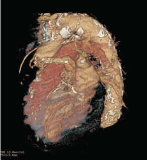 Figure 2. 3D reconstruction from CT angiogram