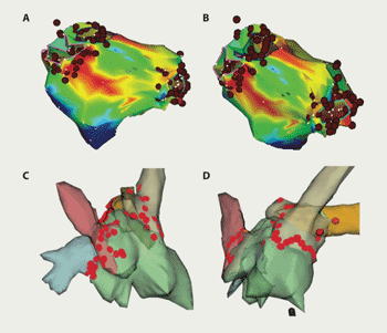 Figure 1. Example of CARTO (A and B) and NavX (C and D) computer maps of the left atrium showing lesion sets to isolate pulmonary veins