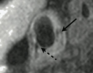 Figure 1. 3T magnetic resonance imaging (MRI) of atherosclerotic plaque in a right common carotid artery. The vessel wall is lined with complicated, lipid-rich plaque, which has a necrotic core (solid arrow). A thin fibrous cap can be seen in the bottom-left of the image (dashed arrow)