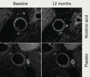 Figure 2. Effect of nicotinic acid on the carotid artery. Nicotinic acid is seen to prevent progression of carotid arterial wall thickening, while patients treated with placebo show clear progression of wall thickness