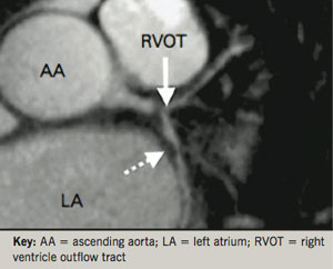 Figure 3. Magnetic resonance arteriography (MRA) of the left main stem, showing two separate plaques, which are seen as dark areas on the bright-blood signal (arrows). Adapted from Kim et al.13