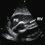 Subxiphoid pericardiocentesis guided by contrast echocardiography in a patient with cardiac tamponade