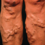 Varicose veins, haemorrhoids and the risk of circulatory diseases: record-linkage study