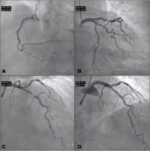 Figure 5. Angiographic vs. functional evaluation of coronary stenosis. Clinical case 1.