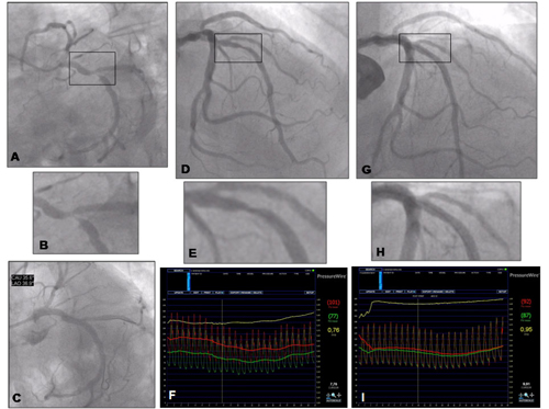 Figure 6. Angiographic vs. functional evaluation of coronary stenosis. Clinical case 2.