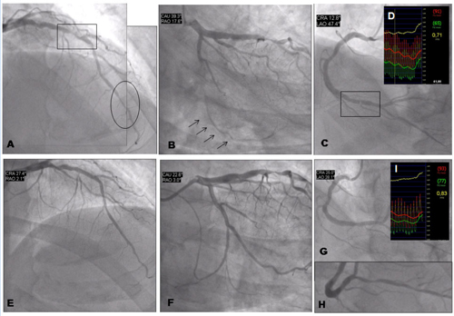 Figure 7. Revascularisation for silent ischaemia. Clinical case 3.