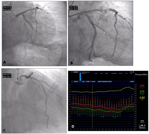 Figure 8. Decision making in the acute phase of STEMI. Clinical case 4.