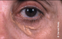 Figure 2. Xanthelasma represent areas of lipid-laden macrophages. The presence of these is predictive of an increased risk of coronary heart disease, atherosclerosis and mortality