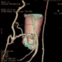 Does CT coronary angiography have a role in the evaluation of patients with CABG?