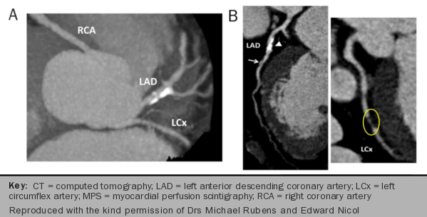 Angina module 5: advanced cardiac imaging - The British Journal of ...