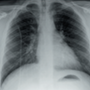 Massive inferior venacavo-atrial thrombus following neoadjuvant chemotherapy