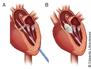 Figure 3. Antegrade (transapical) implantation of a transcatheter heart valve. A) positioning of the deliver catheter across the stenotic aortic valve via the left ventricular apex; B) inflation of the balloon within the native valve deploying the prosthesis.