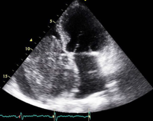 Figure 1. Transthoracic echocardiogram showing a large mass prolapsing through the tricuspid valve and filling the right atrium nearly completely