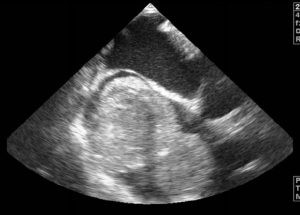 Figure 4. Intraoperative transoesophageal echocardiogram showing the prolapsing right atrial mass