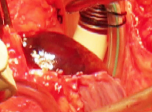 Figure 5. Intraoperative picture showing a large dusky, purple mass filling the entire right atrium