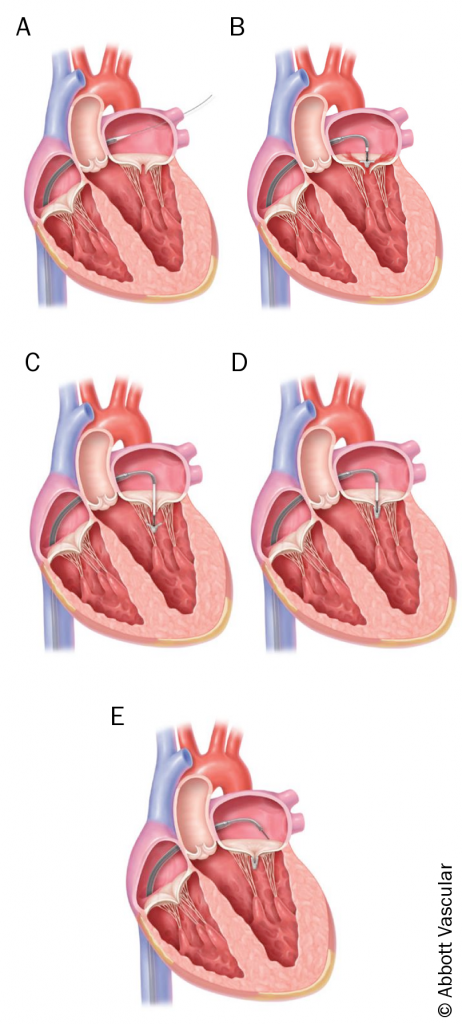 Figure 9. Delivery of valve repair clip: A) trans-septal crossing; B) clip alignment to line of coaptation; C) clip opened in left ventricle; D) clip closed; E) clip deployed