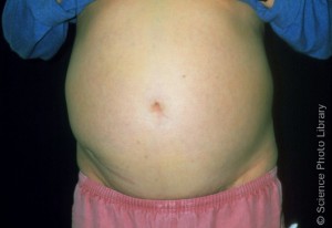 M1080478-Ascites_of_abdomen-SPL