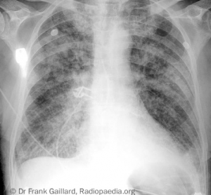 Figure 11. Severe pulmonary oedema