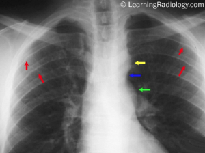 Figure 7. Close up of upper thorax in a patient with coarctation of the aorta, indicating rib notching caused by the dilated intercostal arteries (red arrows), the aortic knob (yellow arrows), the actual coarctation (blue arrows) and the post-stenotic dilation of the descending aorta (green arrows)