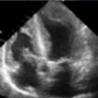 An update on treatments for amyloid heart disease