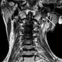 Recurrent syncope in head and neck cancer: a case report with literature review