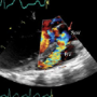 Giant aortic sinus fistula