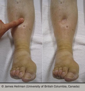 Pedal oedema during and after the application of pressure to the skin