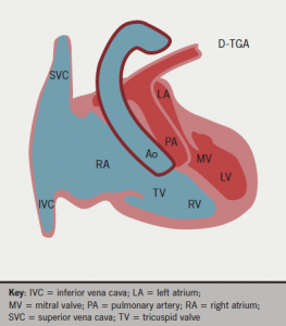 Figure 1a. Schematic representation of transposition of great arteries (D-TGA). The aorta (Ao) originates from the right ventricle (RV) and the pulmonary artery (PA) from the left ventricle (LV)