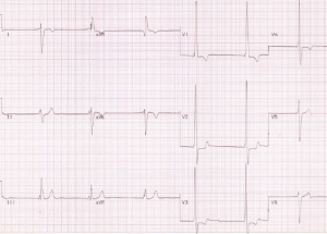 Figure 1b. Electrocardiogram (ECG) from a patient with transposition of great arteries (D-TGA) treated by the Mustard procedure. It shows junctional bradycardia, right axis deviation, and right ventricular hypertrophy