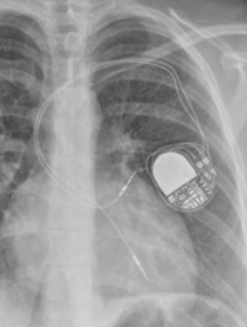 Figure 1c. After a Mustard or Senning procedure, if dual-chamber pacing is required, the atrial lead may be passed behind the baffle into the left atrium (LA) and actively fixed to the roof of the LA. The ventricular lead follows the same route into the LA and then is advanced across the mitral valve into the left ventricle (LV), where it is actively fixed