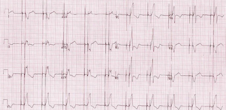 Figure 1e. Complete heart block in a patient after a Mustard procedure