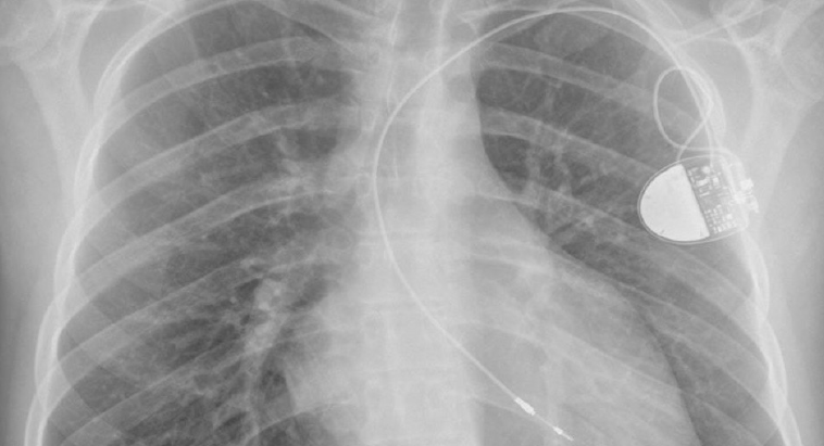 Figure 1h. After a Mustard procedure, if atrial fibrillation and a slow ventricular rate are present, or if atrial pacing is not possible, a single active-fixation lead can be passed into the left ventricle and attached to a rate-responsive pacemaker. This 19-year-old man had transposition of the great vessels, had an atrial septostomy at day 1 and a Mustard procedure at 15 months of age. At the age of 12 years he developed complete heart block. No acceptable pacing threshold could be obtained in the baffle or LA and so the proposed dual-chamber procedure was changed to a Thera SR rate-responsive pacemaker using a single, actively-fixed LV lead. Seven years later, the generator was replaced by an IdentityTM SR (St. Jude Medical) and six years later by a Symphony SR device (Sorin) – both as a result of battery depletion