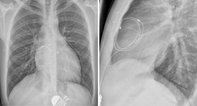 Figure 2d. After closure of a peri-membranous ventricular septal defect with a Dacron patch, atrioventricular block is not uncommon. This patient developed complete heart block five years later and a Legend VVIR pacemaker was implanted using a single ventricular lead. When SVC obstruction developed as a result of lead adhesion/fibrosis accompanied by a very low lead impedance, it was decided to remove the lead and dilate the SVC obstruction and implant a DDDR device instead. However, it proved impossible to either remove the adherent lead or dilate the stenosis. Surgical treatment was, therefore, performed to remove the lead and repair the SVC obstruction, at which time an endocardial lead was fixed in the RA and tunnelled to the epigastrium. An epicardial lead was attached to the surface of the RV and the lead tunnelled to the epigastrium where both leads are attached to a DDDR generator and buried behind the rectus sheath