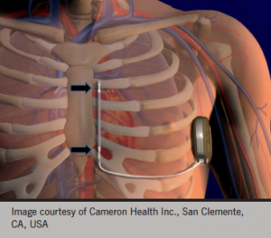 Figure 3a. Schematic representation of the subcutaneous implantable cardioverter defibrillator (ICD) system manufactured by Cameron Health. It is a 9 Fr lead with two sense electrodes (arrows). Multiple sense vectors are automatically analysed to identify the most robust cardiac signal. The maximum shock energy is 80 J delivered in a biphasic fashion