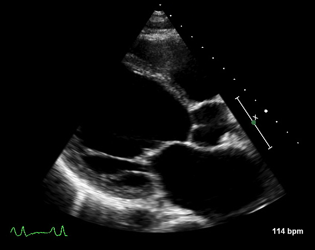 Figure 6. Echocardiogram showing dilated left ventricular end-diastolic and end-systolic dimensions in a patient with heart failure