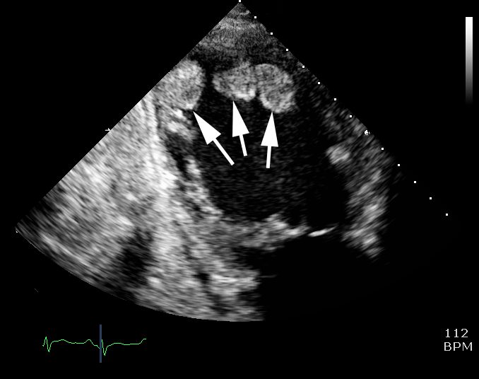 Figure 7. Echocardiogram showing intra-cardiac thrombus