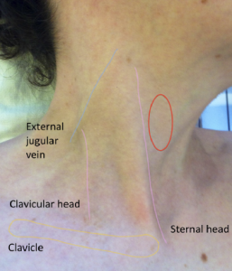 Figure 1. External anatomical landmarks (lightly traced in colour). The red circle shows the region where the internal jugular vein will be observed when distended