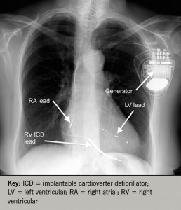 Heart failure learning module 4: device therapy and other management ...