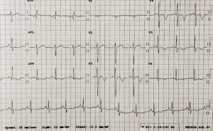 Figure 1. The electrocardiogram (ECG)showing deep inferolateral T-wave inversion