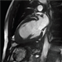 Endomyocardial fibrosis in hypereosinophilic syndrome