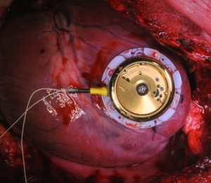 The energy harvesting device is sutured directly onto the myocardium