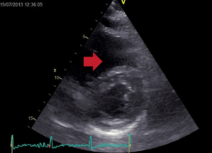 Figure 2a. Flattening of the interventricular septum in systole suggestive of pressure overload (arrow)