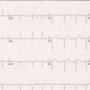 Risk of mortality and cardiovascular outcomes among patients newly diagnosed with atrial fibrillation