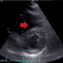 Troponin biomarkers: the benefits of echocardiography in a presumed diagnosis of NSTEMI