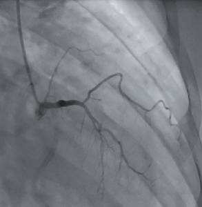 Figure 1. Anteroposterior (AP) view, showing the hypoplastic left anterior descending (LAD) arising from right coronary cusp